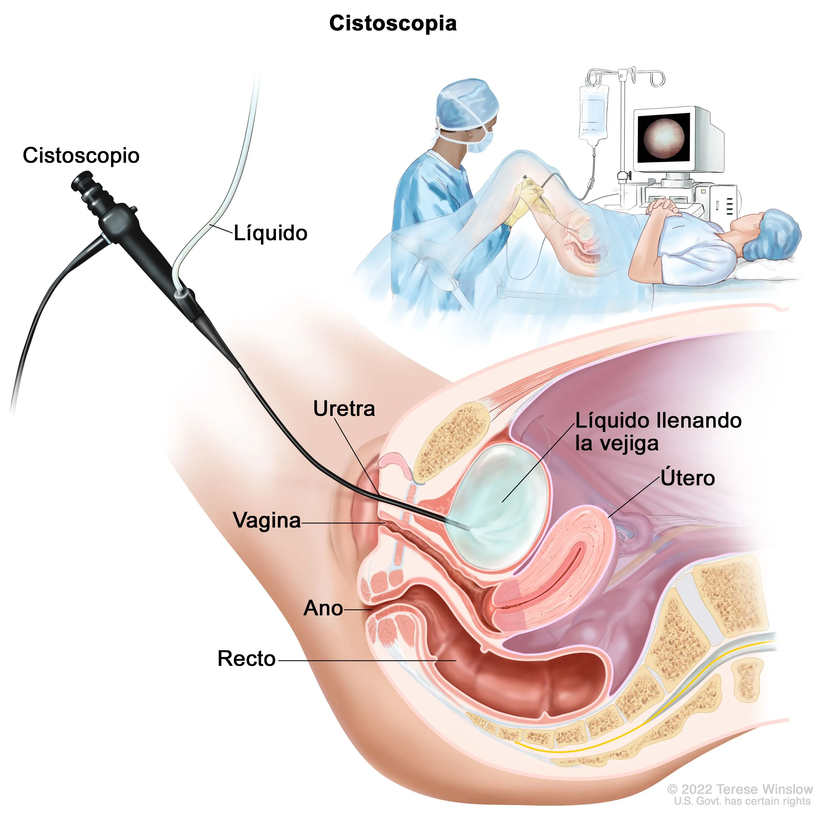 Cistoscopia