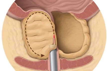 HOLEP (enucleación láser de próstata)