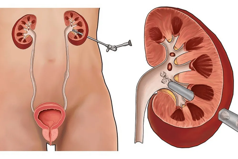 Cirugía percutánea renal (NLPC)