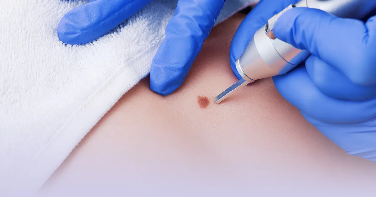 Tratamiento de verrugas genitales (VPH)