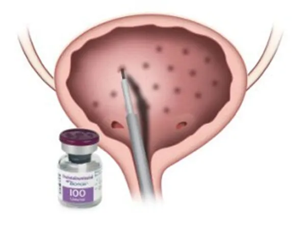 Inyecciones de bótox en la vejiga