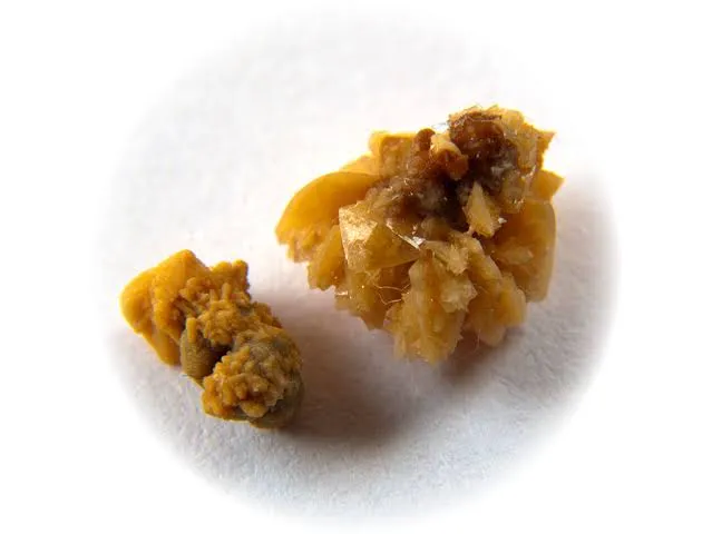 Cálculos renales (piedras en el riñón)