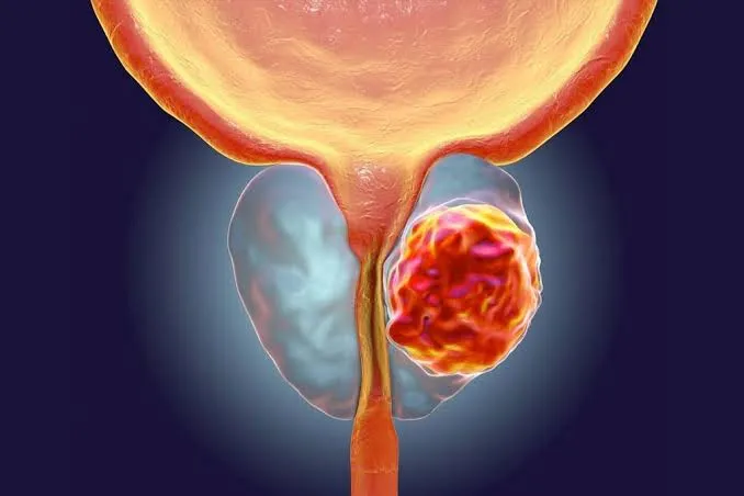 Cáncer de próstata explicado: síntomas, PSA y factores de riesgo