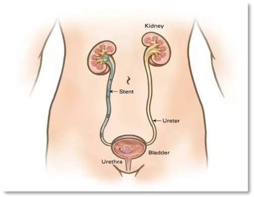 Catéter doble J (stent ureteral)