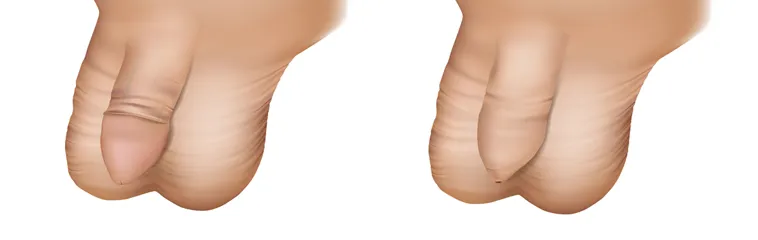 Fimosis y circuncisión