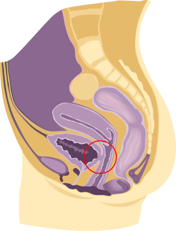 Fístula vesicovaginal