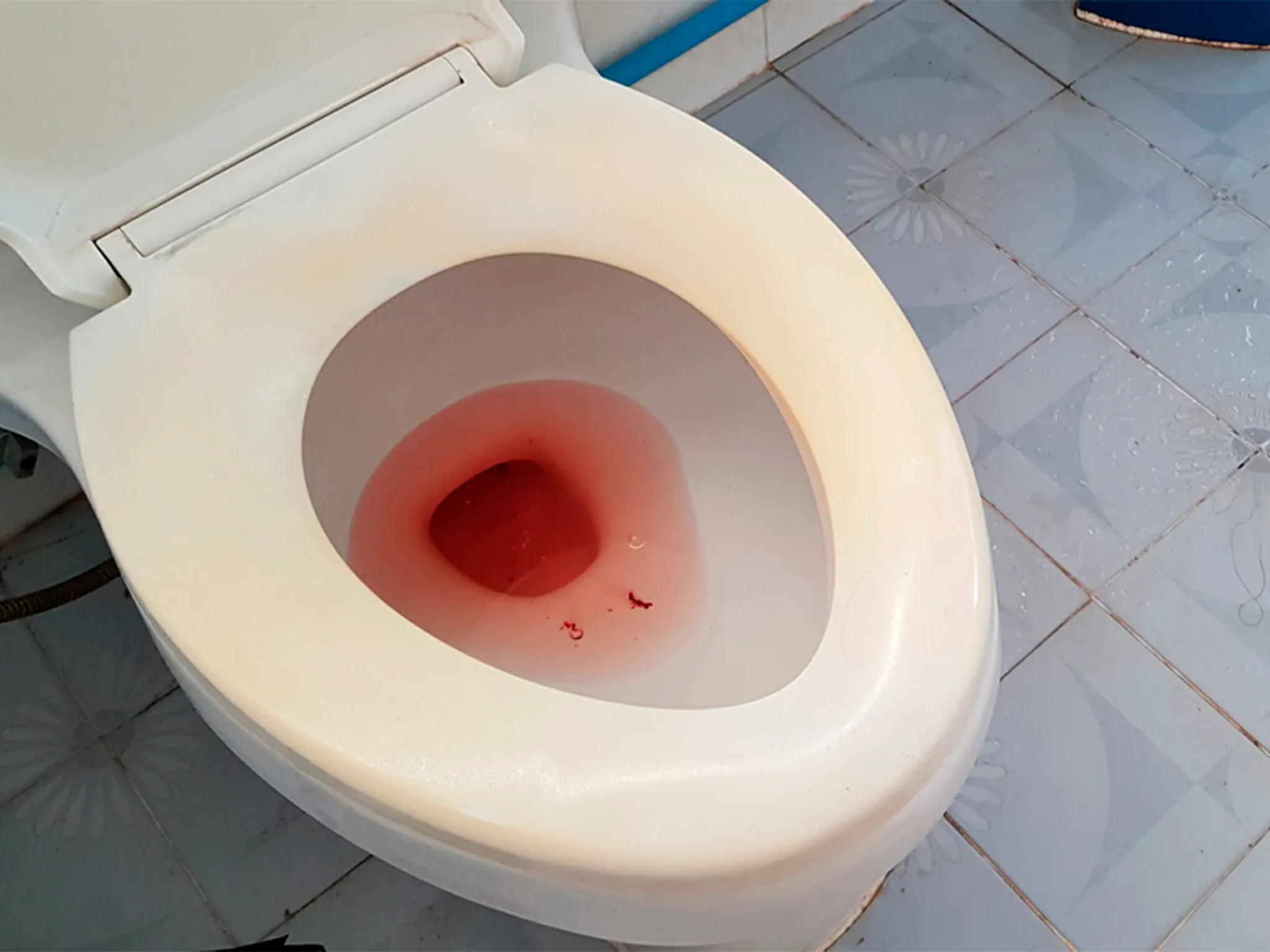 Sangre en la orina o hematuria: causas, estudios y cuándo acudir