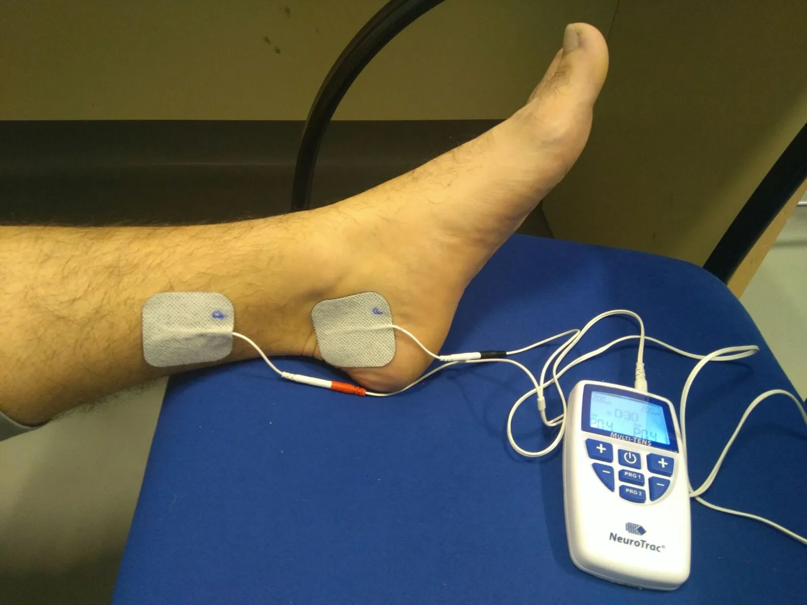 Neuromodulación del nervio tibial posterior para la vejiga en Culiacán