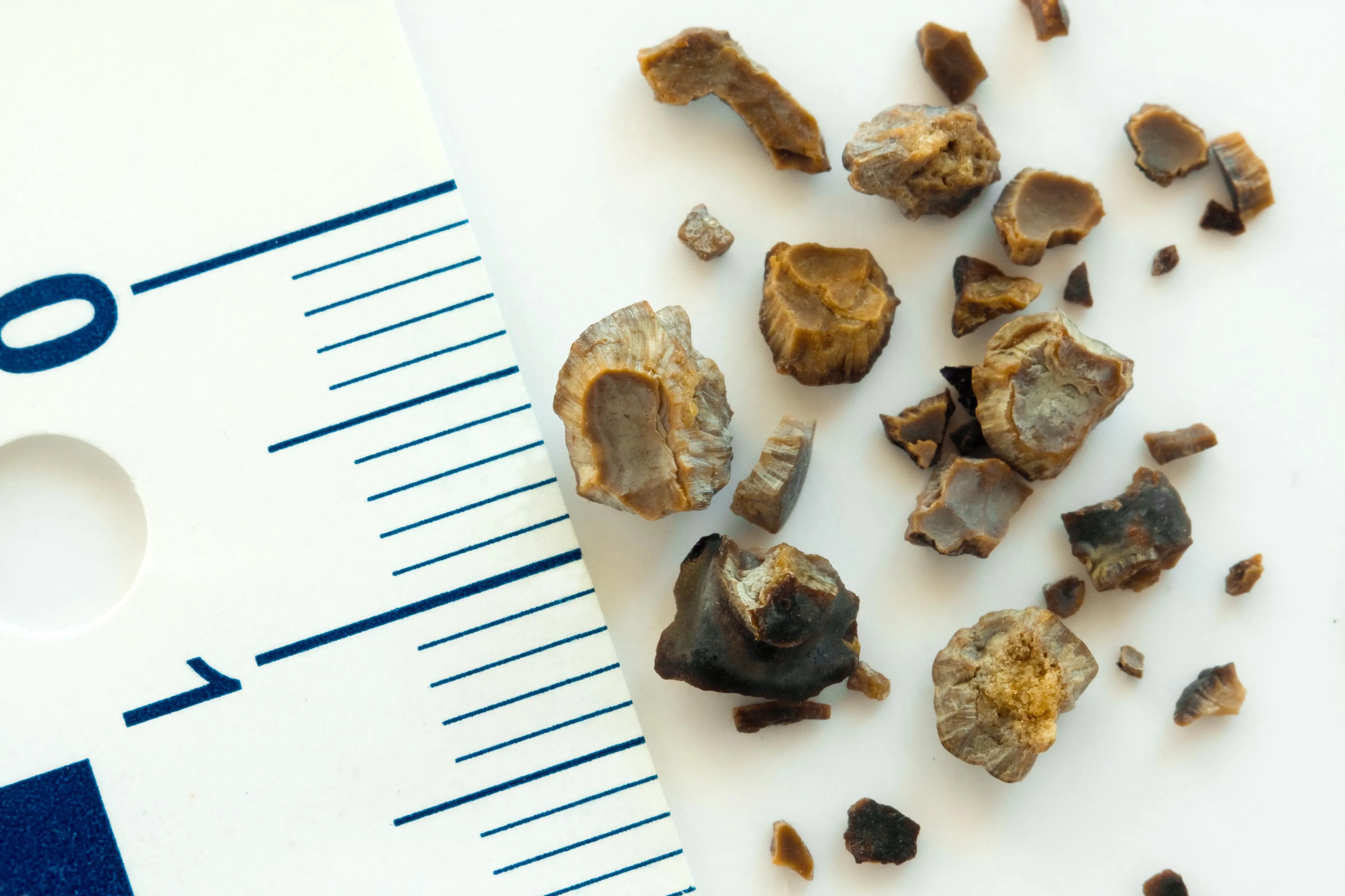 Cálculos renales, piedras en el riñón: causas, síntomas y prevención