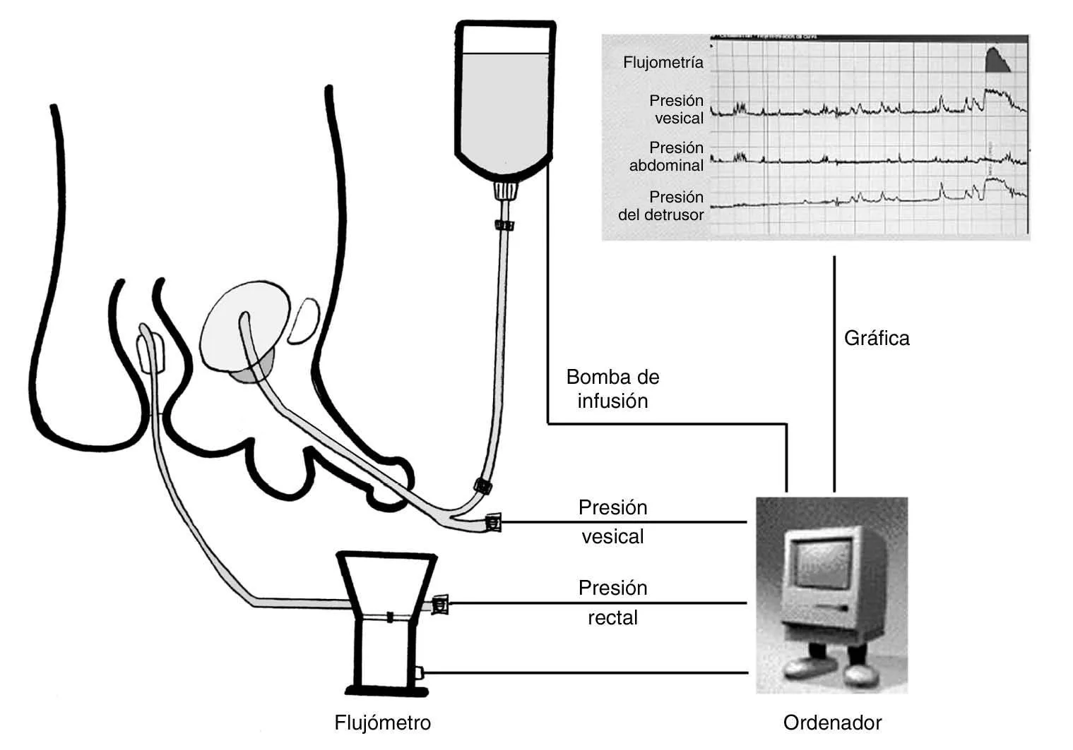 Estudio urodinámico de presión-flujo en Culiacán