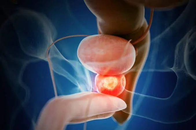 Urología oncológica en Culiacán con el Dr. Miguel Sandoval