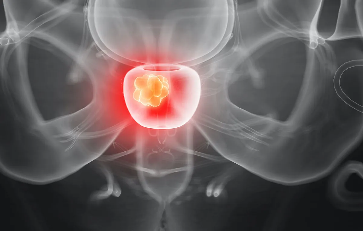 Prostatitis, próstata inflamada: tipos, síntomas y tratamiento