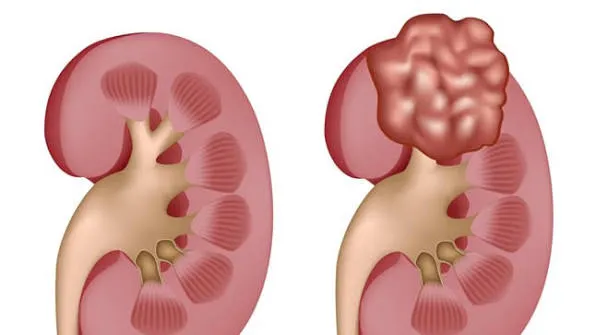 Cáncer de riñón