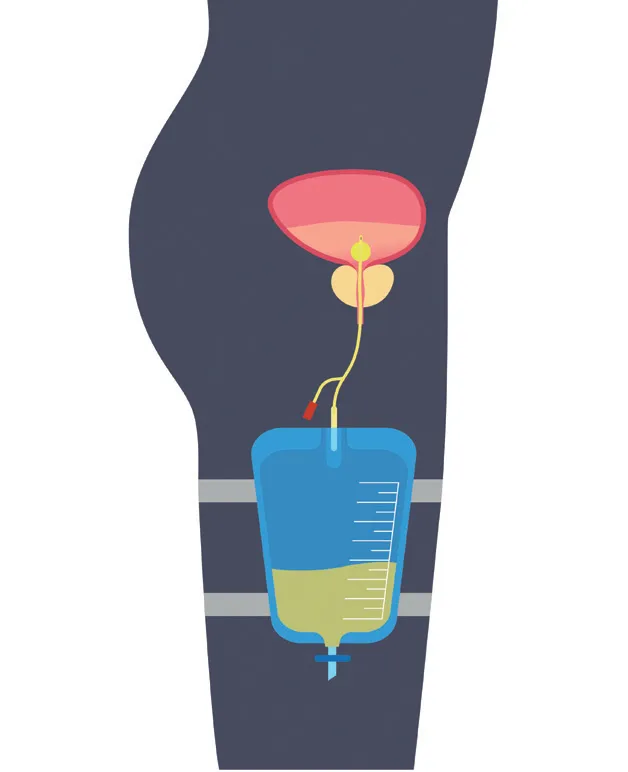 Colocación de sonda urinaria