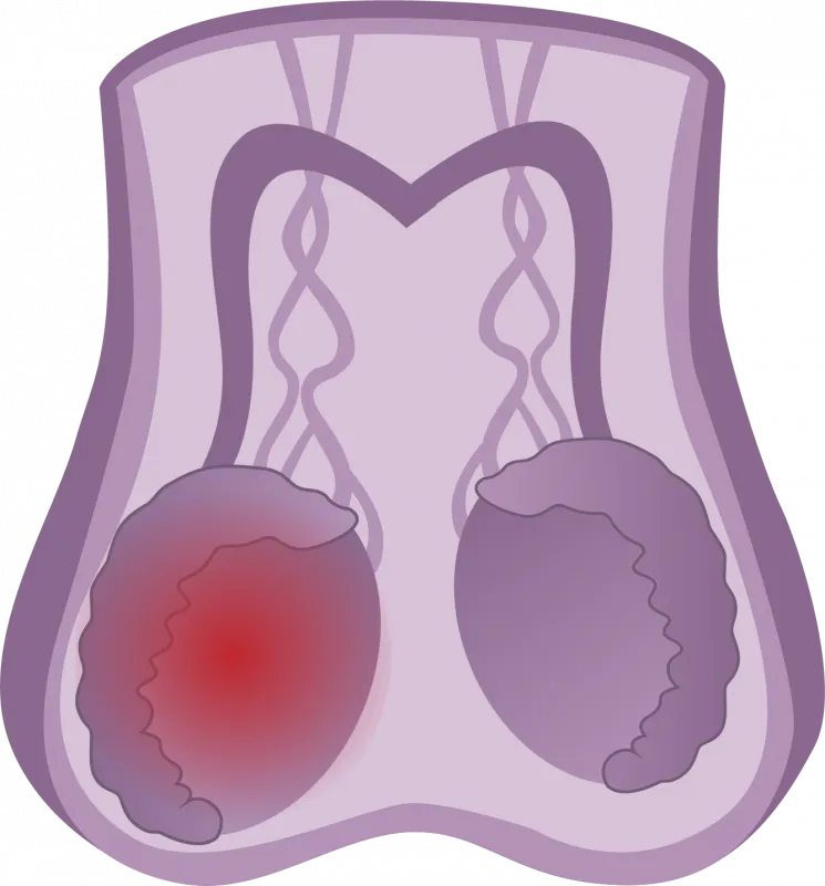 Cáncer de testículo