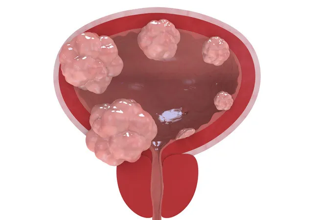 Cáncer de vejiga