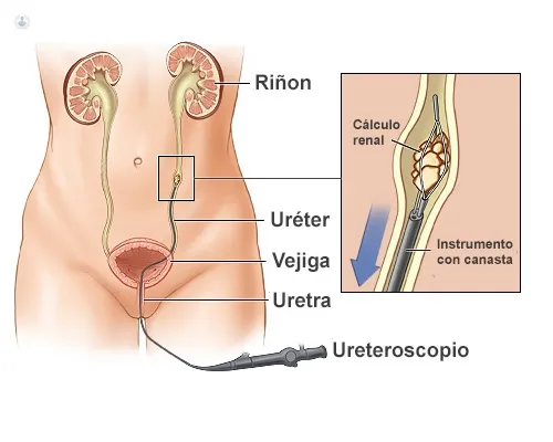 Ureteroscopía láser