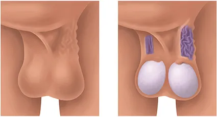 Varicocele (varicocelectomía)