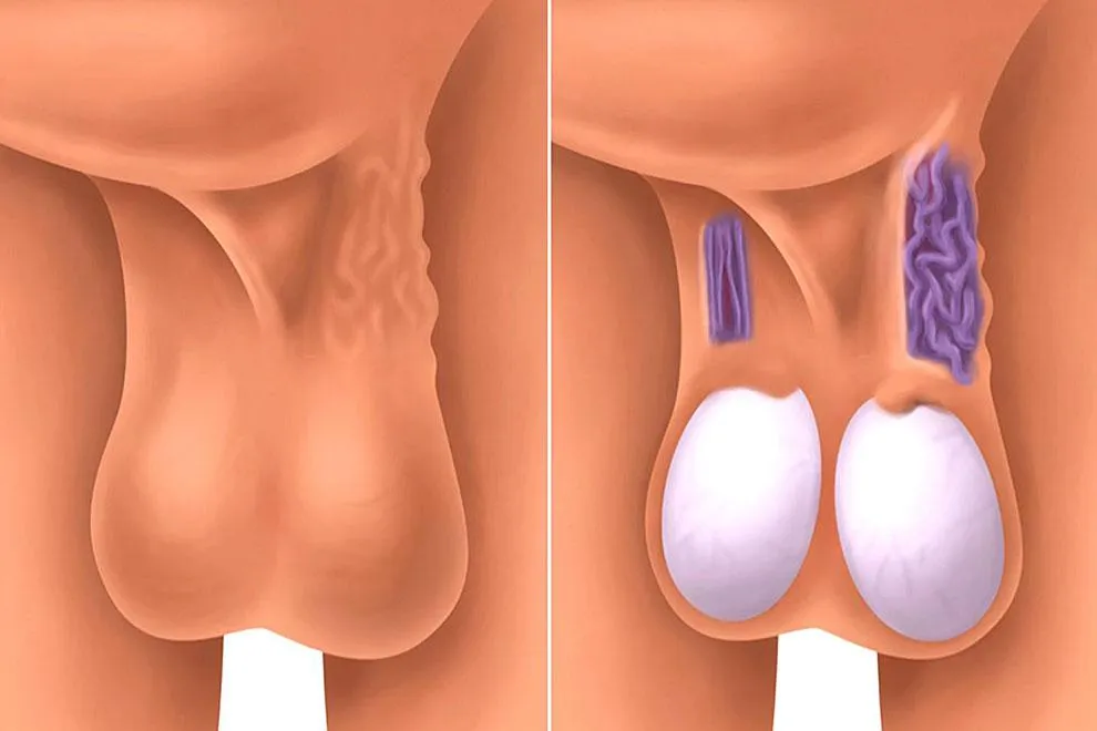 Varicocele