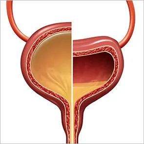 Vejiga neurogénica