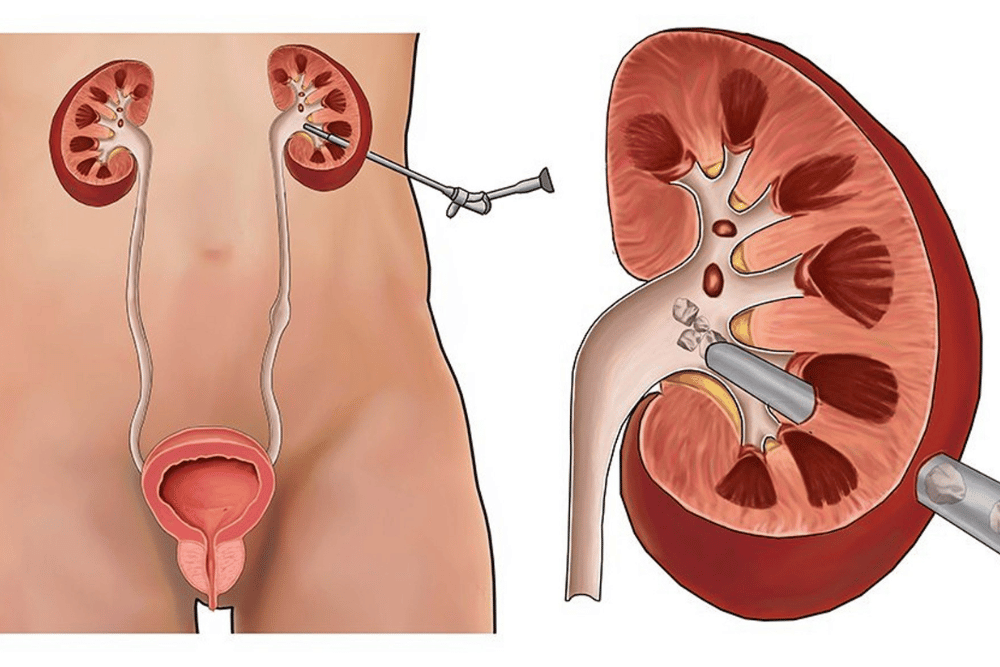 Cirugía percutánea renal (NLPC)