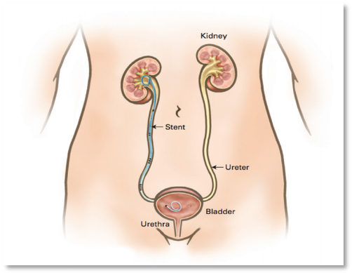 Catéter doble J (stent ureteral)