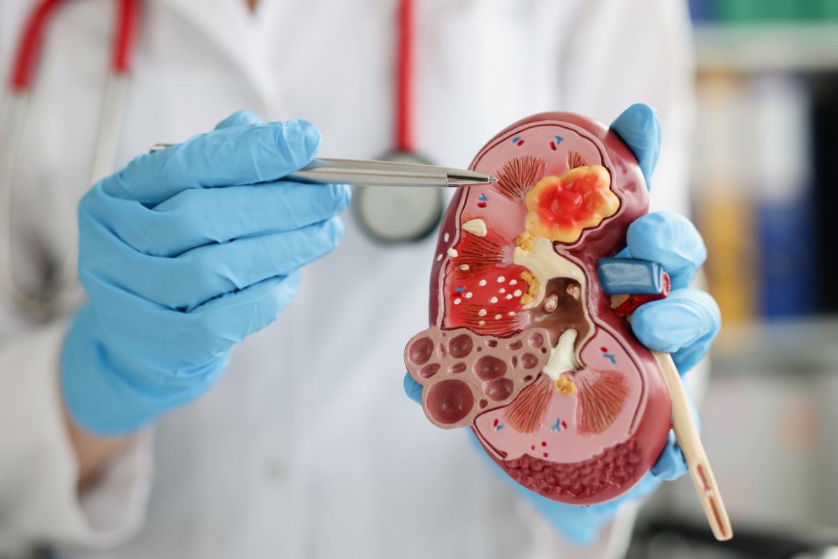 Quiste renal (destechamiento)