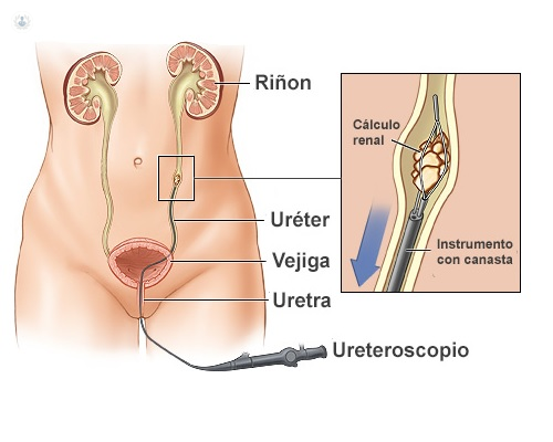 Ureteroscopía láser